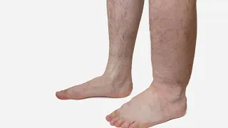 Leg Swelling