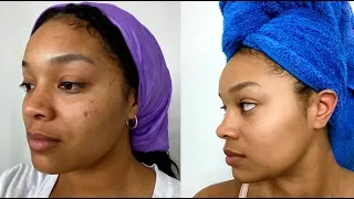 CHEMICAL PEEL AT HOME! BEFORE & AFTER (EBANEL SKINCARE)