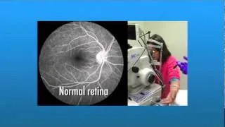 Fluorescein Angiography for AMD