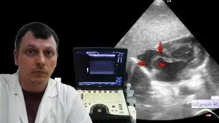 Pediatric Echocardiography -  Floating IAS aneurysm