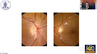 Ischemic optic neuropathy - Dr. Sachin Kedar