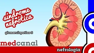 Síndrome Nefrótica | GLOMERULOPATIAS 5