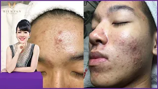 Cyst Acne popping | Điều trị mụn hiệu quả số 1 TPHCM |Hiền Vân Spa |Hoàng Bảo Ngọc P3 | 556