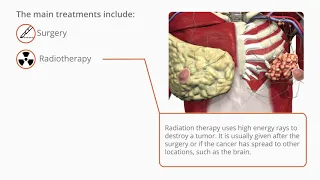 Diseases and Conditions: Treatments of Breast Cancer