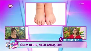 Ödem nedir?