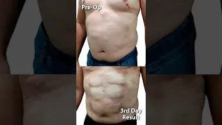 Incredible Six Pack Abs Surgery Result After Just 3rd Days! Get Abs Without Workout #shorts #abs