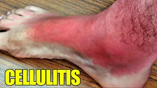 Cellulitis!  Complicated Cellulitis Infections & Abscesses