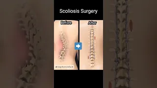 Surgery for Spine Scoliosis (Minimally Invasive). #spine #scoliosis #backpain