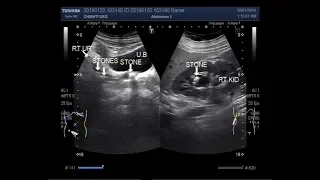 Ultrasound Video showing a renal stone with multiple ureteric stones.