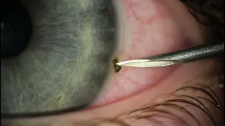 Removing Metal from 6-year-old's Eye