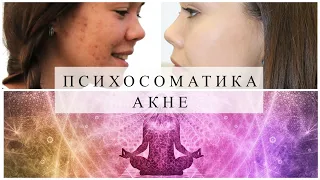 ПСИХОСОМАТИКА АКНЕ. Как избавиться от прыщей? #акне #проблемнаякожа #прыщи