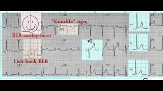 pericarditis or BER on ECG