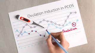 Ovulation Induction in PCOS
