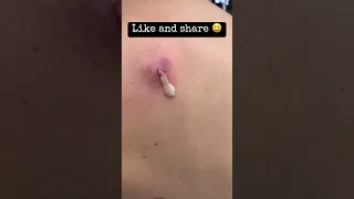 Massive Spot Pimple Popping on Back