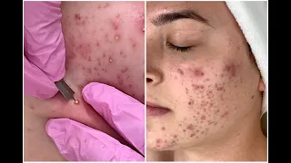 Acne Scars & Blemish Brightening + Clearing Facial | Jadeywadey180