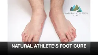 How To Cure Athlete's Foot Naturally
