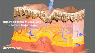 Injection de Botox (injection toxine botulique) - Rides haut du visage - Dr Federico Loreto