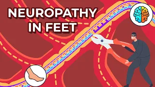 Dealing with Neuropathy in Feet: Causes, Symptoms, and Treatments