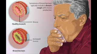 Bronchiectasis | Definition, Causes, Signs and Symptoms, Investigation and Management