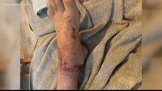 Florida teen survives shark bite at St. Augustine Beach