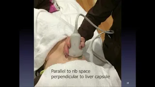 Ultrasound Liver Elastography