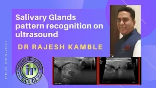 TMT: Pattern Recognition in Salivary Gland Lesions by Dr Rajesh Kamble