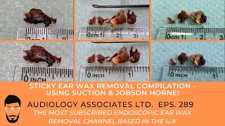 STICKY EARWAX REMOVAL COMPILATION - SUCTION/JOBSON HORNE - EP 289