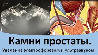 Камни простаты.  Лечение электрофорезом и ультразвуком.