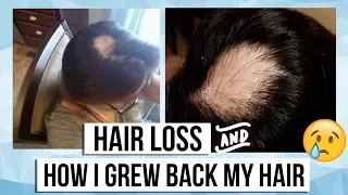 My Alopecia Areata Story (Hair Loss) + Products I used to grow my hair back!