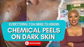 Everything You Need to Know About a VI Peel | Chemical Peel Near Me