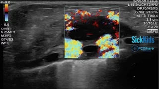 3 Rules for Assessing Soft Tissue Infections Using POCUS