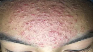 Acne Treament Under The Skin #052