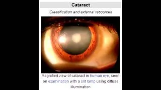 Cataract - Define & Risk Factors