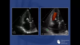 Novel Application of MitraClip for the Tricuspid Valve - Paul Sorajja, MD