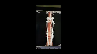 شرح فحص الاشعه المقطعيه بالصبغه علي اوردة الطرف السفلي  CT Lower limb venography