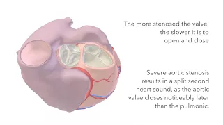 Aortic Stenosis - Murmur Sound & Animation