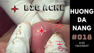 #018 | Super BIG acne all over the face | Mụn siêu to khắp mặt | Hương Đà Nẵng | akne Behandlung