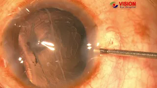 Corneal Injury Capsular injury and Cataract-Dr.Siddiqur Rahman