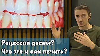 Dental Stories // Рецессия десны: что это и как это лечить? Рассказываю на примере моего пациента