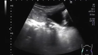 Ultrasound Video showing multiple ureteric stones in a child of about 05 years.