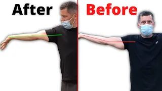 How To Get Full Elbow Extension Back After Injury