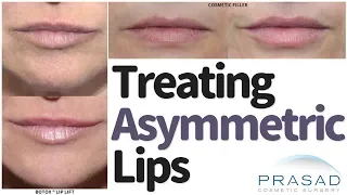 How to Treat Asymmetric Lips and Smiles