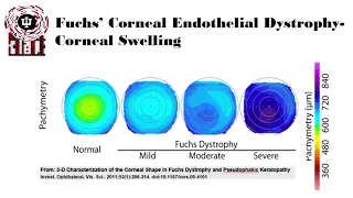 Fuchs Corneal Endothelial Dystrophy