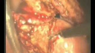Lap Cholecystectomy - IAGES