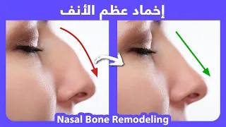 How to naturally get rid of nose hump | كيفية اخماد عظم الانف بطريقة طبيعية بدون جراحة