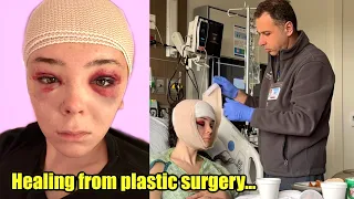 Healing from Facial Feminization Surgery (Plastic Surgery Update)