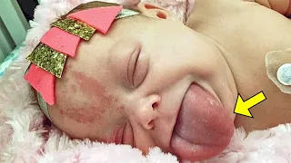 Remember This Baby Born with a Large Tongue? You Won't Believe How She Looks Now!