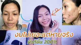 แชร์ ROUTINE รักษาสิวอุดตัน อักเสบ สิวไม่มีหัว (ผิวแข็งแรง+ดีขึ้น 200%) เฮลตี้นี่คะ รักษาสิว