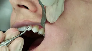 Montana Jack / Nevi 46 Posterior Dental Scaling Video
