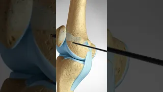 What happens when you dislocate your Knee Cap (MPFL Tears and Reconstruction) #kneeanatomy
